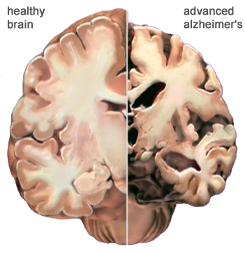 A view of how Alzheimer’s disease changes the whole brain. Left side: normal brain; right side, a brain damaged by advanced AD. 