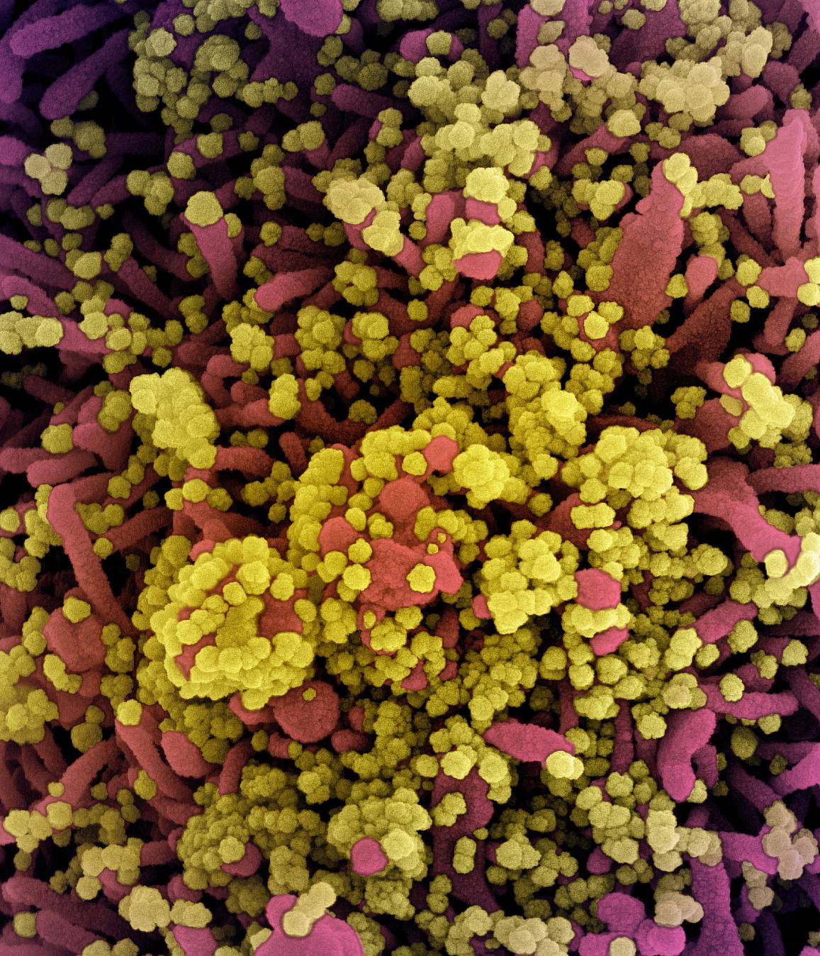 A cell heavily infected with SARS-CoV-2 virus particles (yellow).