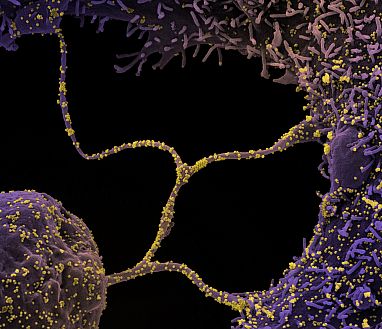 Cells infected with SARS-CoV-2 virus particles (yellow).