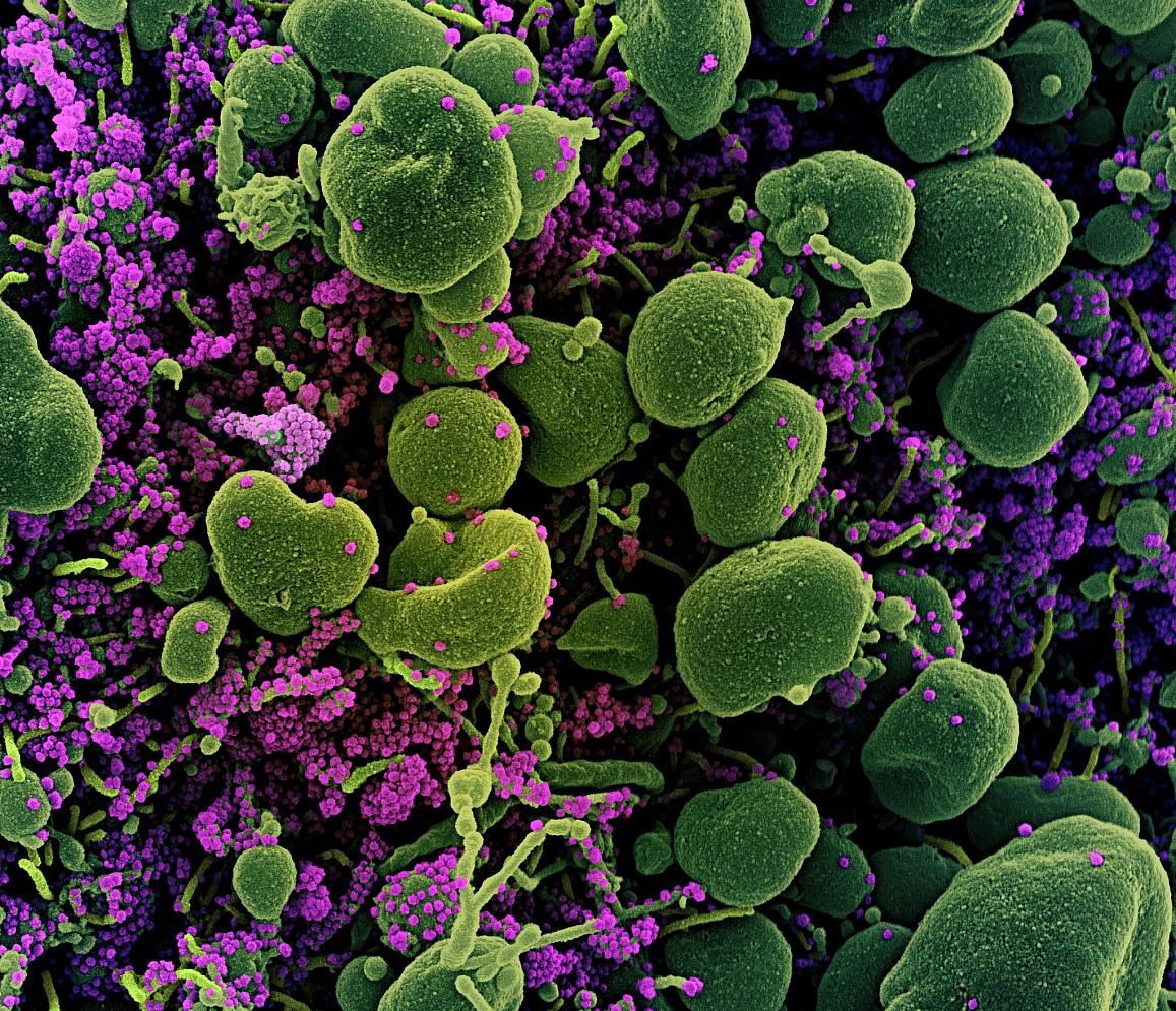 Cell heavily infected with coronavirus.