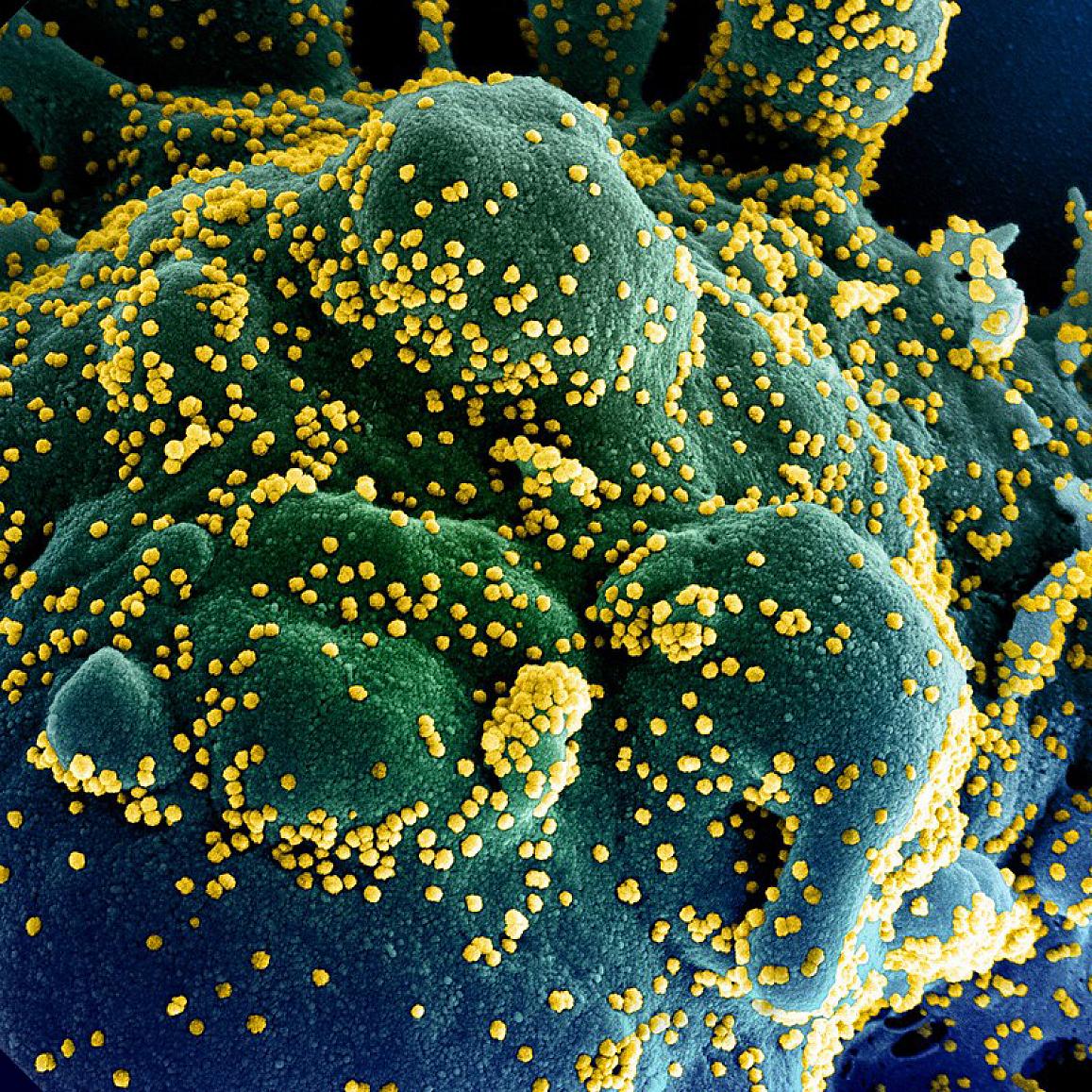 A colorized photo of a cell infected with COVID-19.