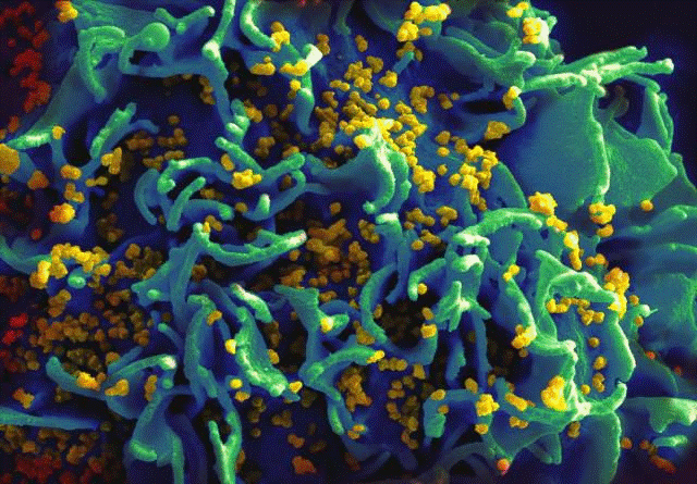 A micrograph of an HIV-infected T-cell.