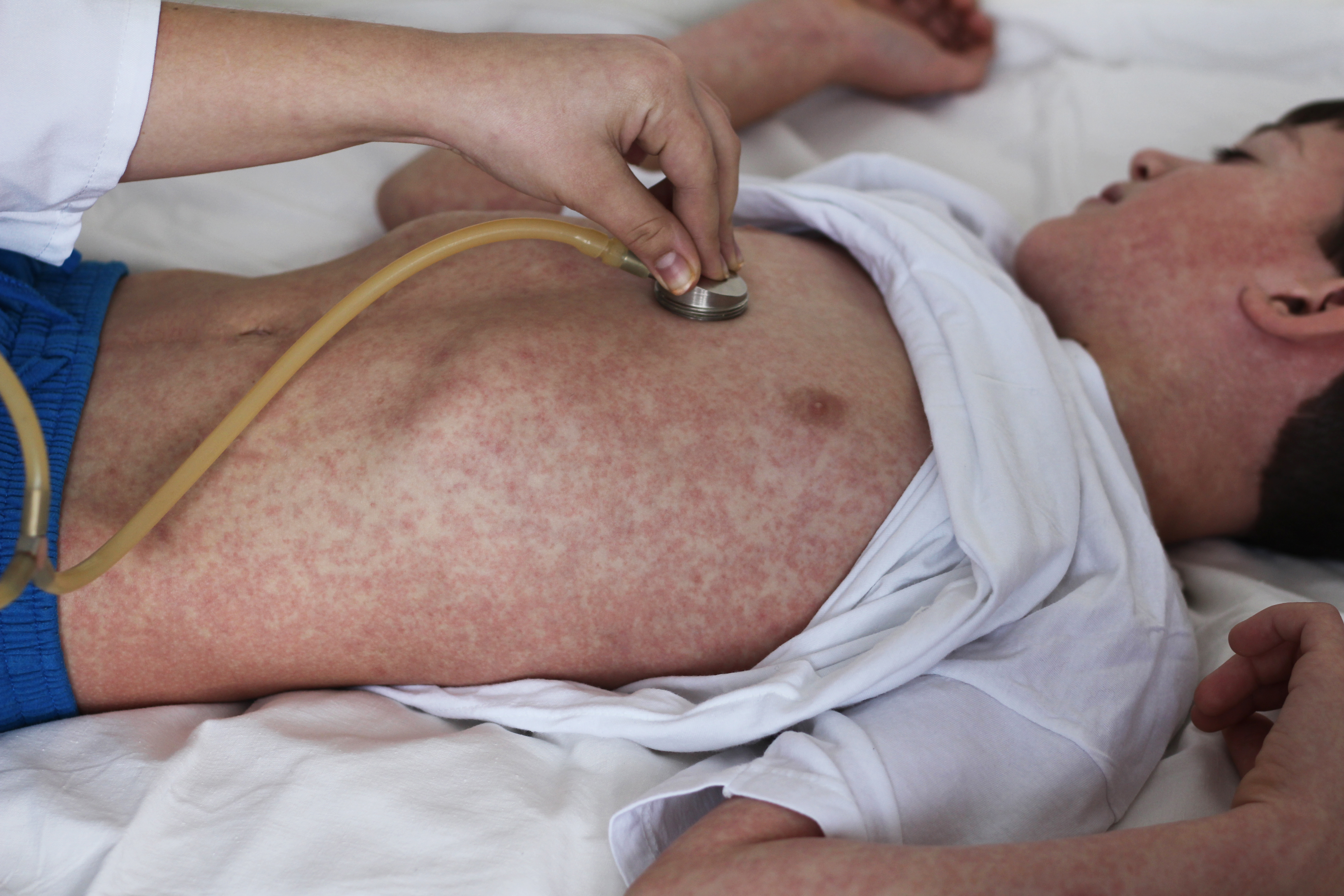 Photo child with measles being examined.