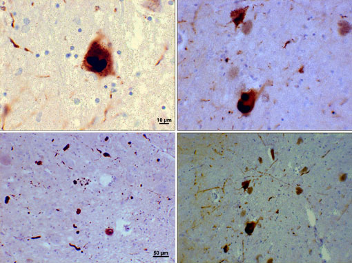 Photomicrograph of regions of substantia nigra in a Parkinson’s patient showing Lewy bodies and Lewy neurites in various magnifications.