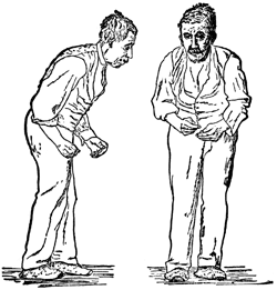 Front and side views of a man with a festinating gait