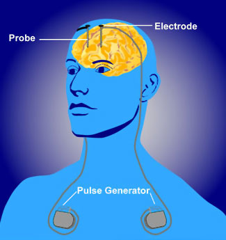 Deep Brain Stimulation Diagram