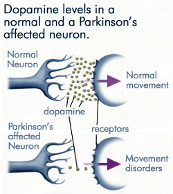 dopaminszintek egy normál és Parkinson-kór által érintett neuronban.