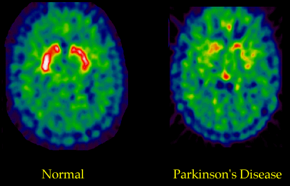 Fluorodopa PET scan comparing a normal brain to a brain affected by PD.