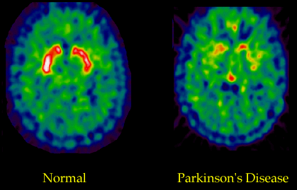 Fluorodopa PET Scan Fluorodopa PET scan comparing a normal brain to a brain affected by PD.