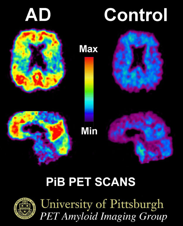 PET Scans Showing PiB Uptake