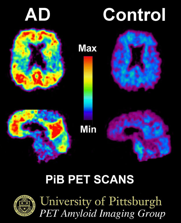 PET Scans Showing PiB Uptake PET Scans Showing PiB Uptake