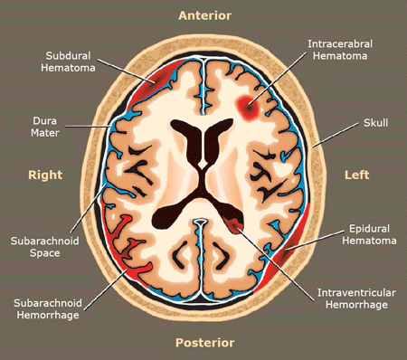 A drawing showing the most common types of hematoma in the human brain.