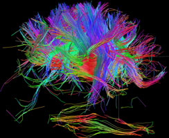 White matter fiber architecture of the brain. Measured from diffusion spectral imaging (DSI). 