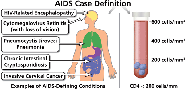 Illustration of AIDS-Defining Conditions