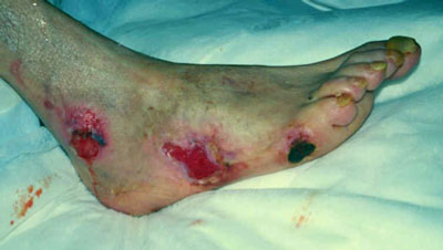 Photo of Arterial Insufficiency Wound