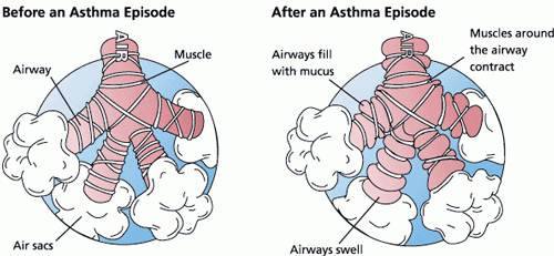 Before and After an Asthma Episode Illustration of an airway before and after an asthma episode.