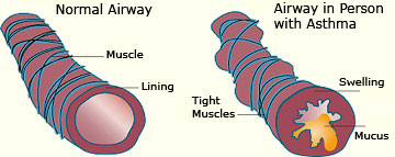 Comparison of Normal and Asthmatic Airways Comparison of Normal and Asthmatic Airways