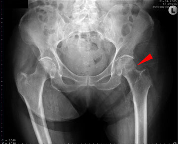 An xray showing a medial hip fracture in a 92-year-old woman.