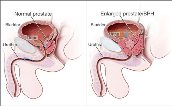 Comparison of Normal and Enlarged Prostate (Illustration)
