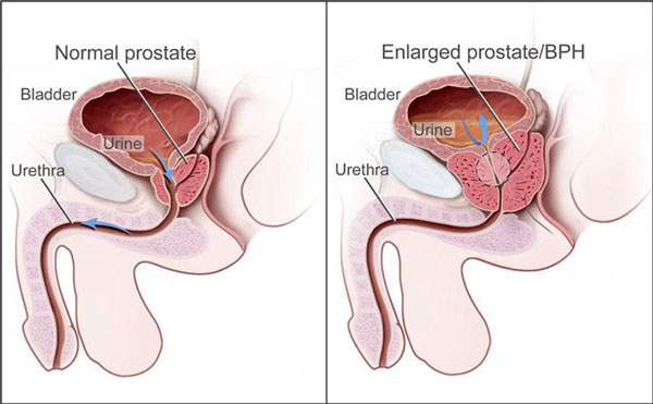Comparison of Normal and Enlarged Prostate (Illustration) Comparison of Normal and Enlarged Prostate (Illustration)