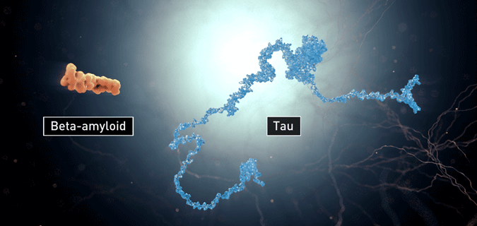 Image: Beta-amyloid plaques and neurofibrillary tangles