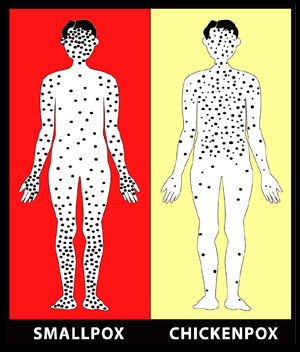 A drawing showing the difference in the rash distribution between smallpox and chickenpox.