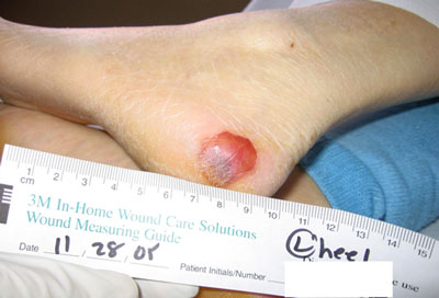 Photo of Blood Filled Blister on Foot