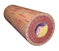 A drawing showing an artery with stenosis.