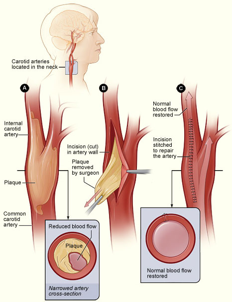 An illustration of the process involved with a carotid endarterectomy.
