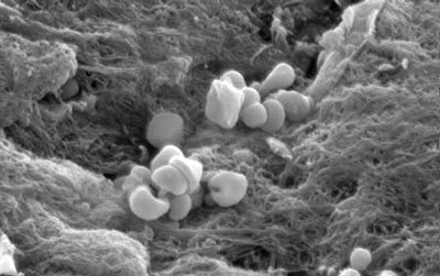 Platelets Attached to Blood Vessels Platelets (magnified here thousands of times) clinging to damaged areas of blood vessels.