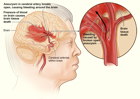 An illustration of a ruptured aneurysm.