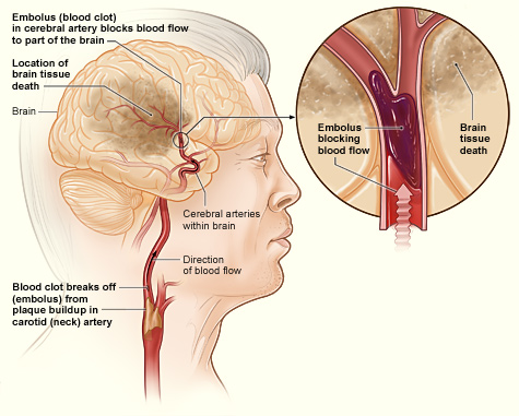 An illustration of a clot causing an ischemic stroke.
