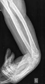 An xray of a wrist contracture related to a stroke.