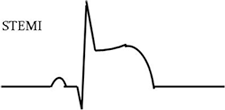 An ECG waveform showing ST-segment evevation.