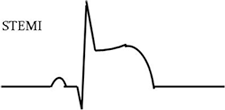 ST-segment Elevation An ECG waveform showing ST-segment evevation.