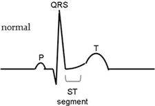 Normal ECG waveform.