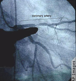 Angiograph of a stenotic segment in a coronary artery.