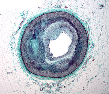 Micrograph of a coronary artery with atherosclerosis and luminal narrowing. 
