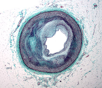 Atherosclerotic Artery with Narrowed Lumen Micrograph of a coronary artery with atherosclerosis and luminal narrowing.