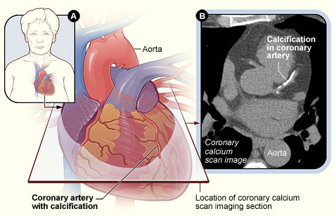 Coronary Calcium Scan Image A scan image showing calcification in a coronary artery.