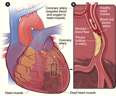 A drawing of the heart showing a myocardial infarct in a coronary artery.