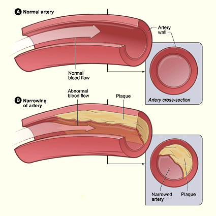 A drawing showing a normal artery and an artery narrowed by plaques.