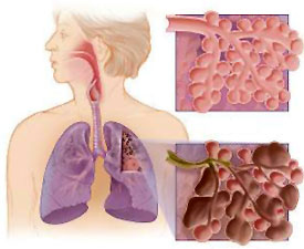 A drawing showing alveoli of a non-smoker compared with alveoli of a smoker.