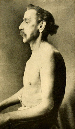 A photograph of a man with barrel chest from COPD.