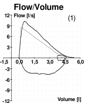 A graph showing peak flow volume for a patient without COPD.