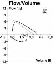 A graph showing peak flow volume for a patient with poor effort.