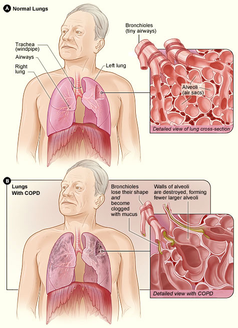 A drawing showing normal lungs compared with lungs damaged by COPD.