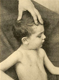 A photgraph of a child with pectus excavatum (pigeon chest).