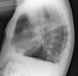 Xray of an 81-Year-Old man with an exacerbation of COPD.
