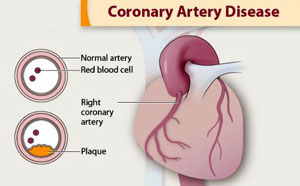 Illustration of coronary arteries and plaque